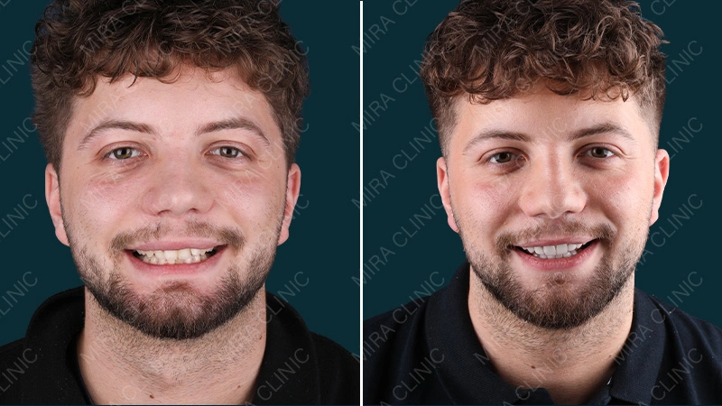 From Doubt to Confidence Hollywood smile 